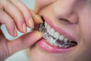 Ortodoncia Invisalign en Pobla de Farnals Valencia
