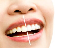 blanqueamiento dental pobla de farnals valencia